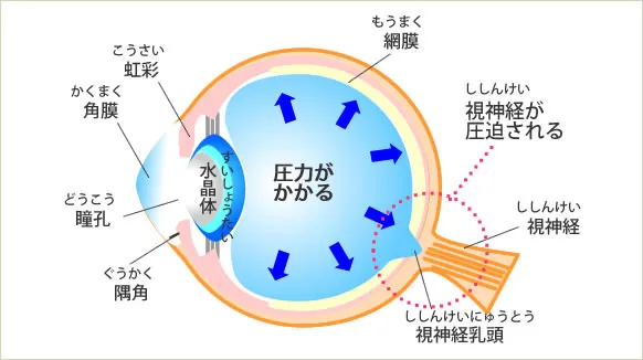 緑内障の原因 緑内障の原因